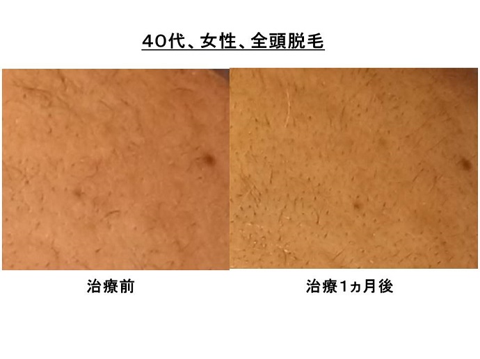 円形脱毛症　病院""